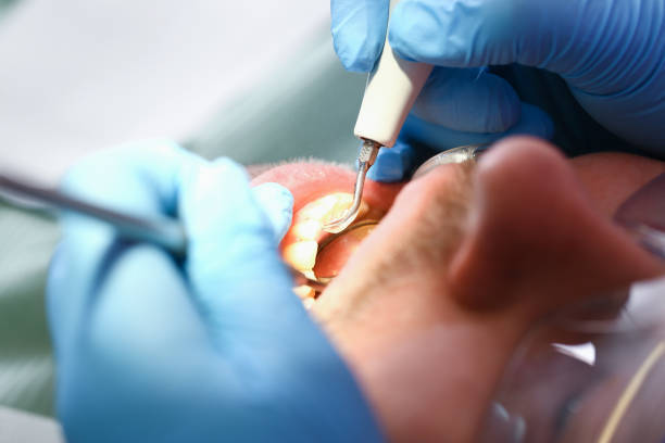 Best Emergency Wisdom Teeth Removal in Potosi, TX